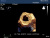 Philips iE33 Аппарат УЗИ